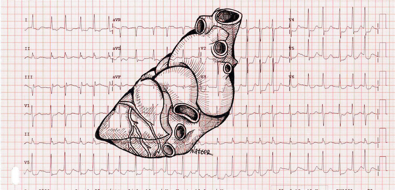 EKG