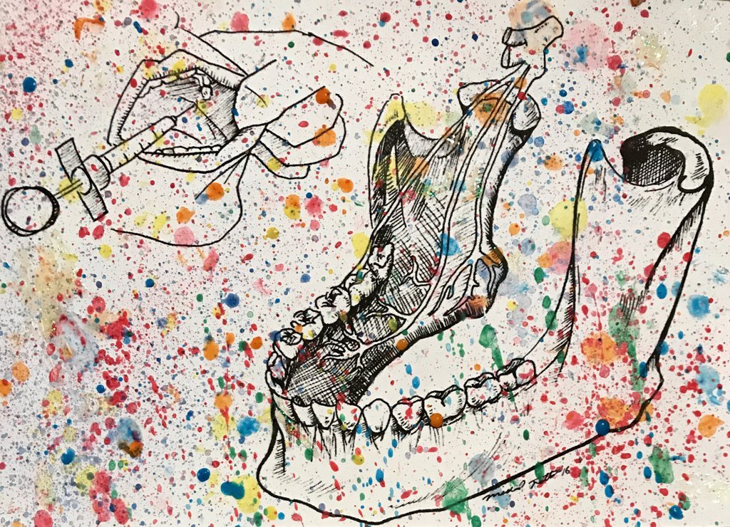 Splatter Inferior Alveolar Nerve