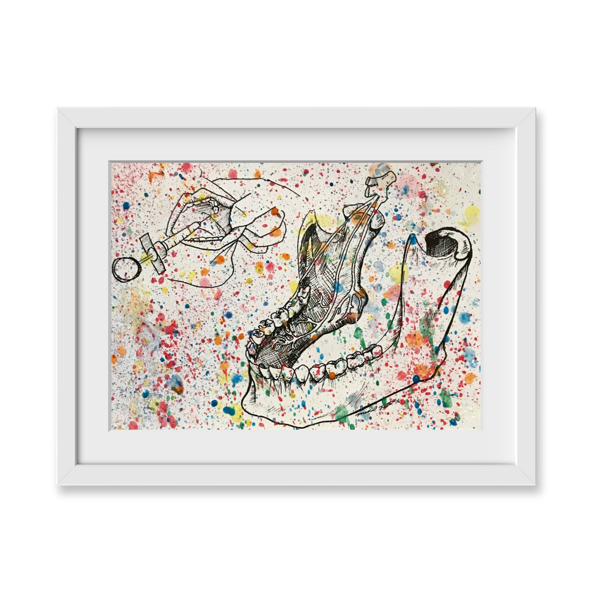 Splatter Inferior Alveolar Nerve