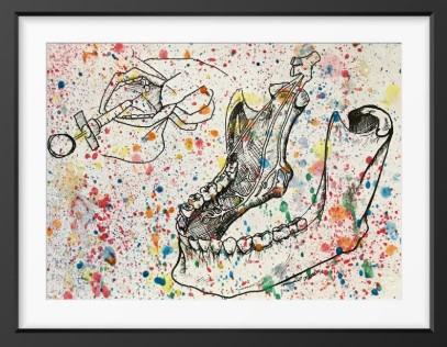 Splatter Inferior Alveolar Nerve