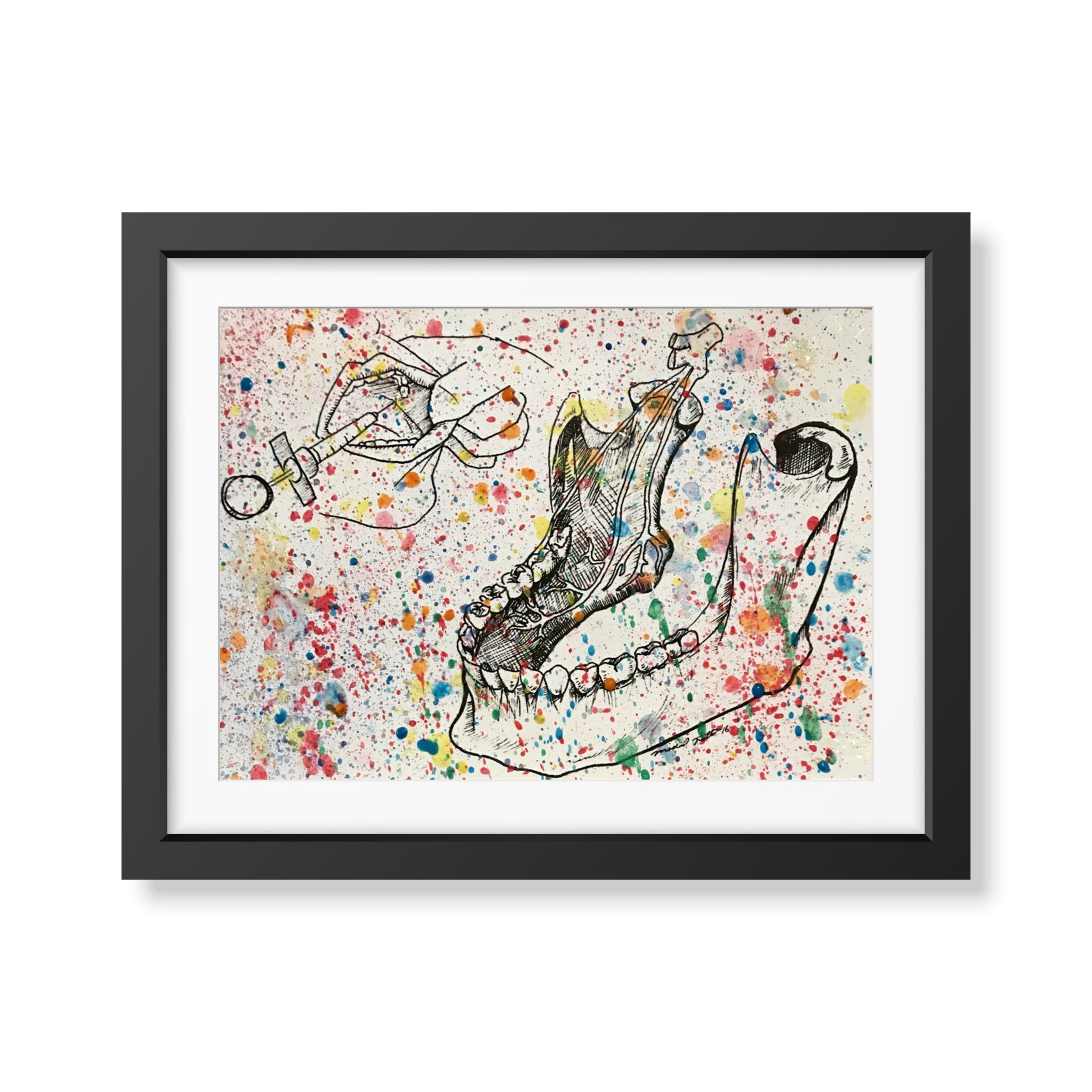 Splatter Inferior Alveolar Nerve