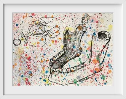 Splatter Inferior Alveolar Nerve